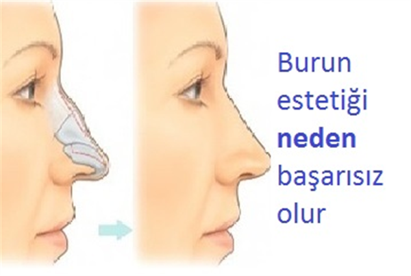 BURUN ESTETİĞİ NEDEN BAŞARISIZ OLUR.